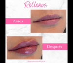 Relleno de labios con ácido hialurónico - Imagen 2