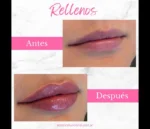 Relleno de labios con ácido hialurónico - Imagen 2