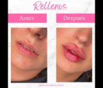 Relleno de labios con ácido hialurónico - Imagen 3