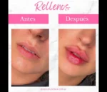 Relleno de labios con ácido hialurónico - Imagen 3