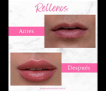 Relleno de labios con ácido hialurónico