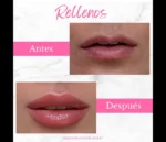 Relleno de labios con ácido hialurónico