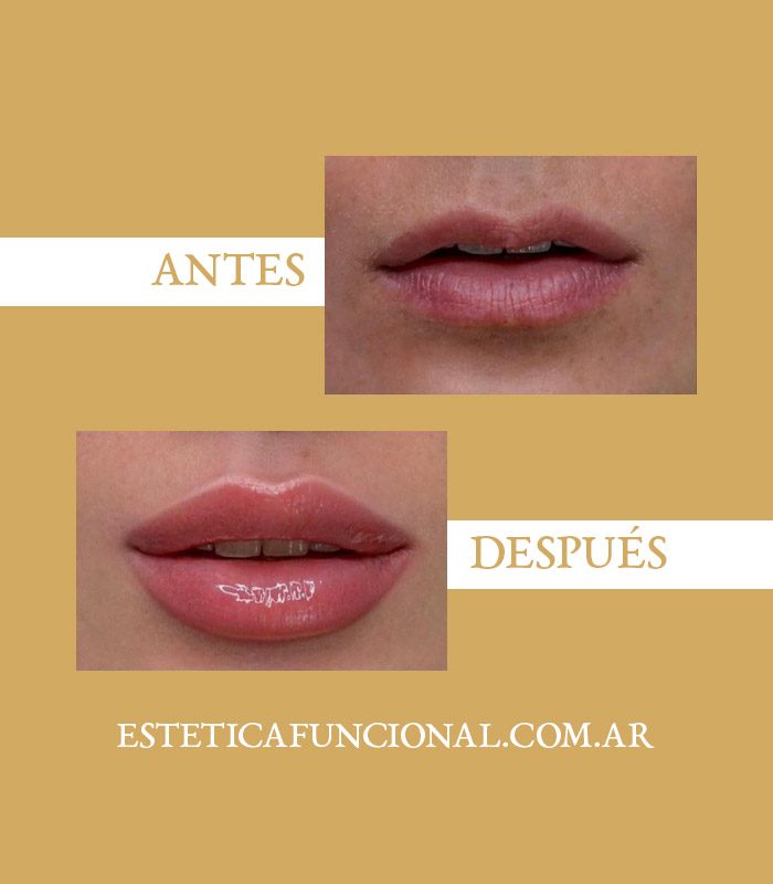 Relleno-de-labios-portada_01