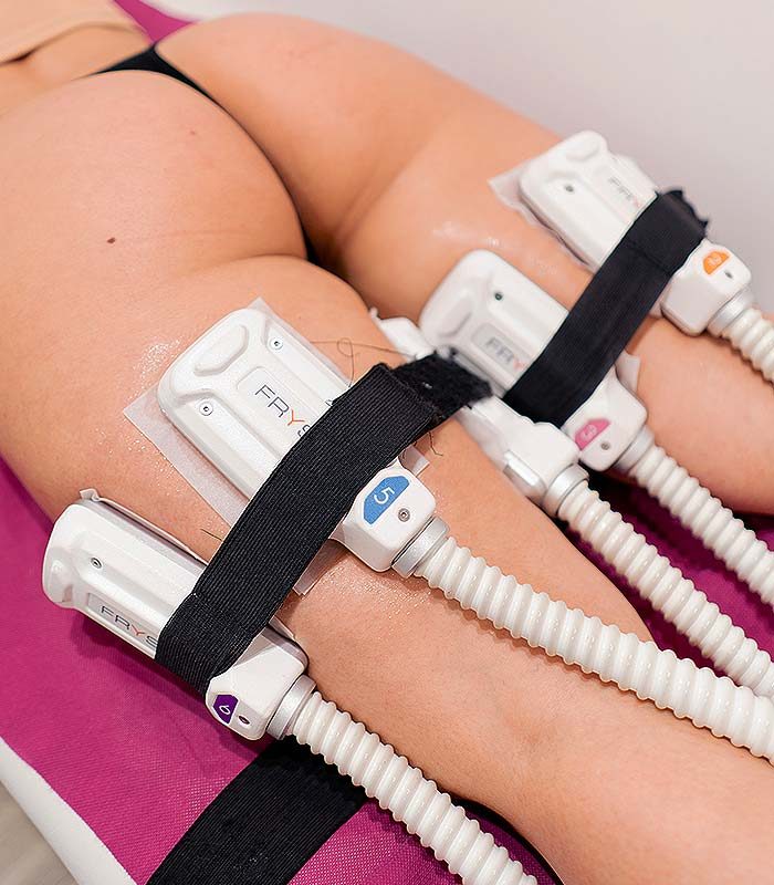 criolipolisis_portada