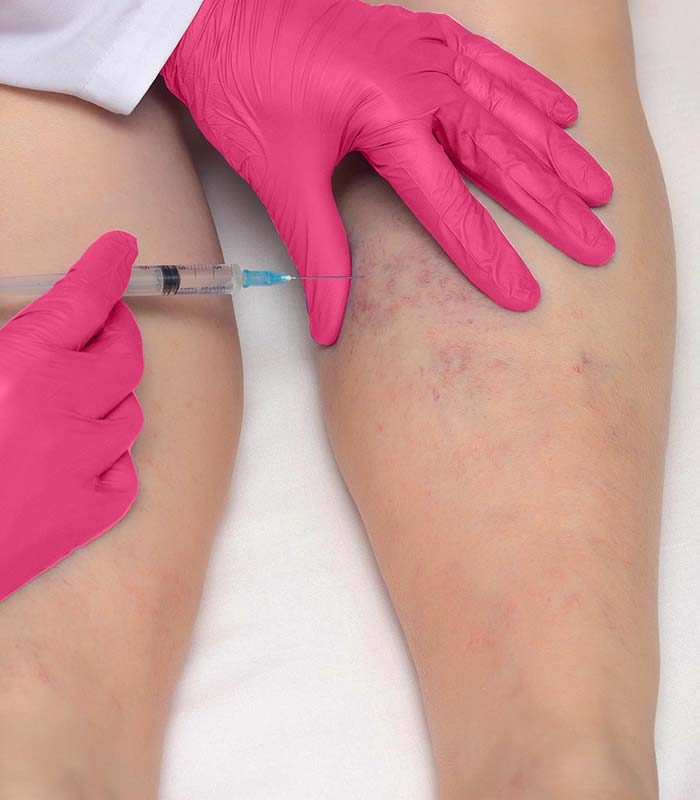 escleroterapia_portada